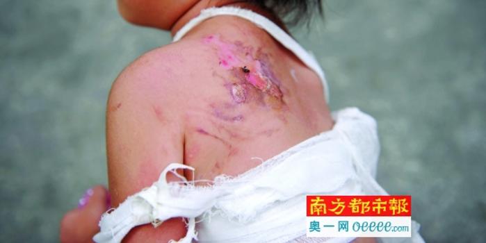 派出所暖心行动，女童烫伤事件背后的深厚友情与爱之陪伴