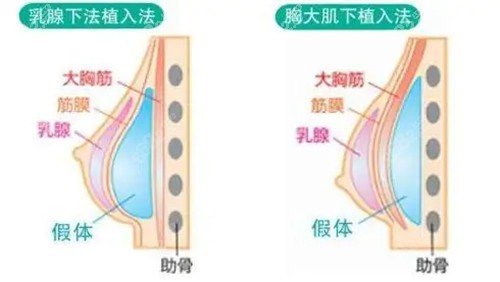 最新隆胸技术详解，最新隆胸技术介绍与解析
