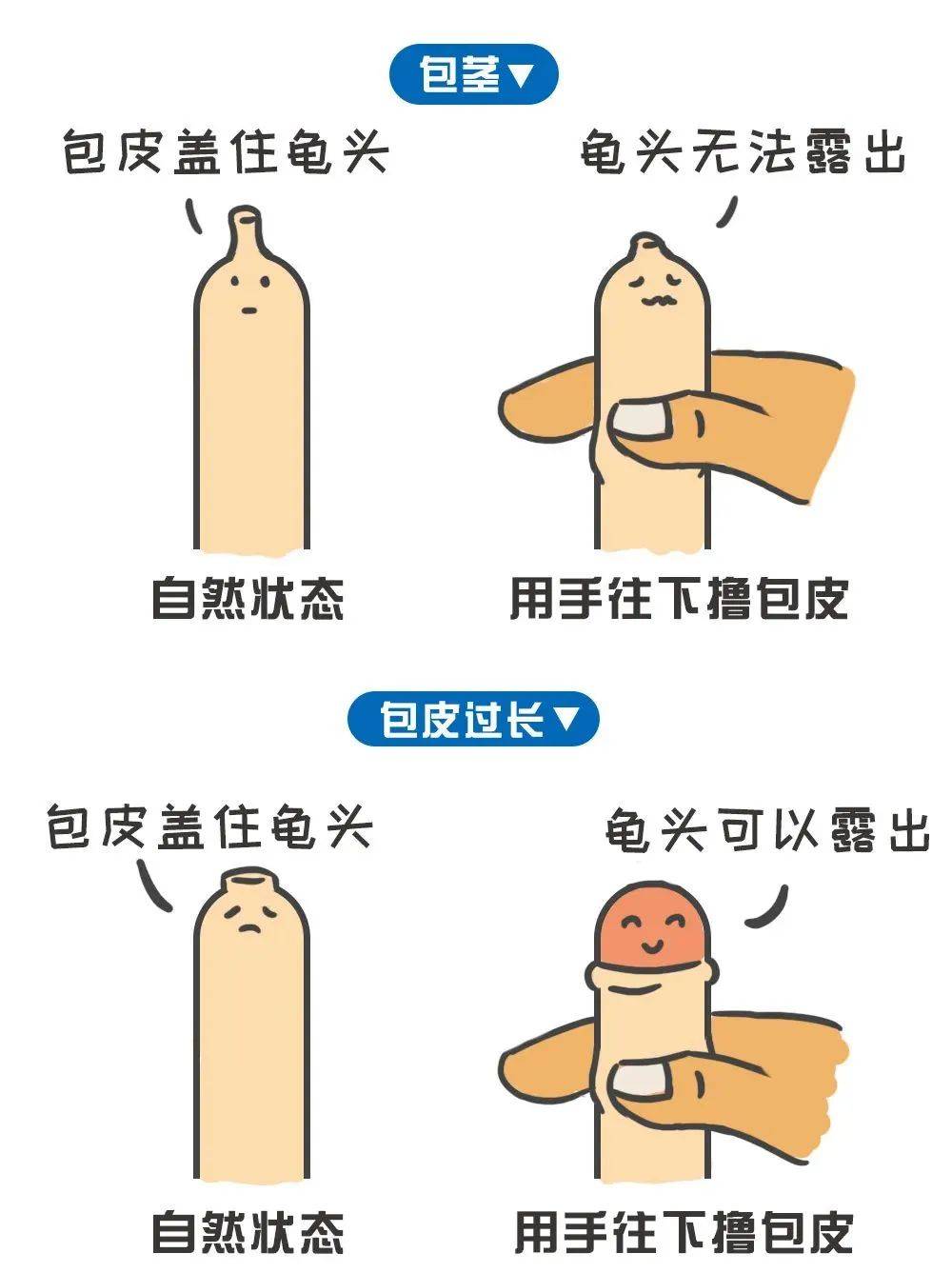 最新包皮手术，小明的手术经历与友情纽带之旅